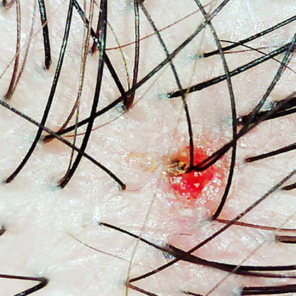 炎症を起こしている毛穴